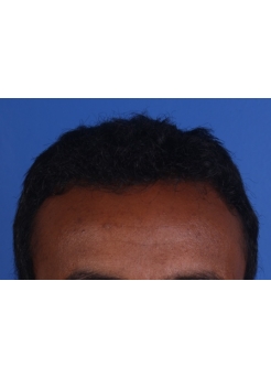 After Hair Transplant&nbsp;Front